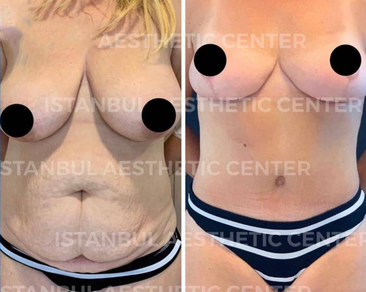 Case 12239 - tummy tuck