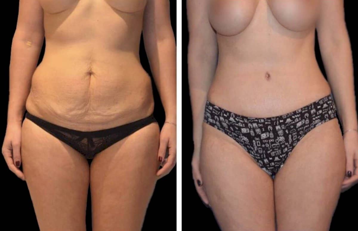 Case 12240 - tummy tuck