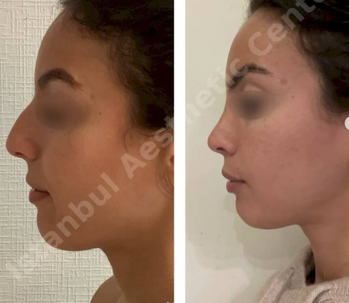 Case 12243 - rhinoplasty