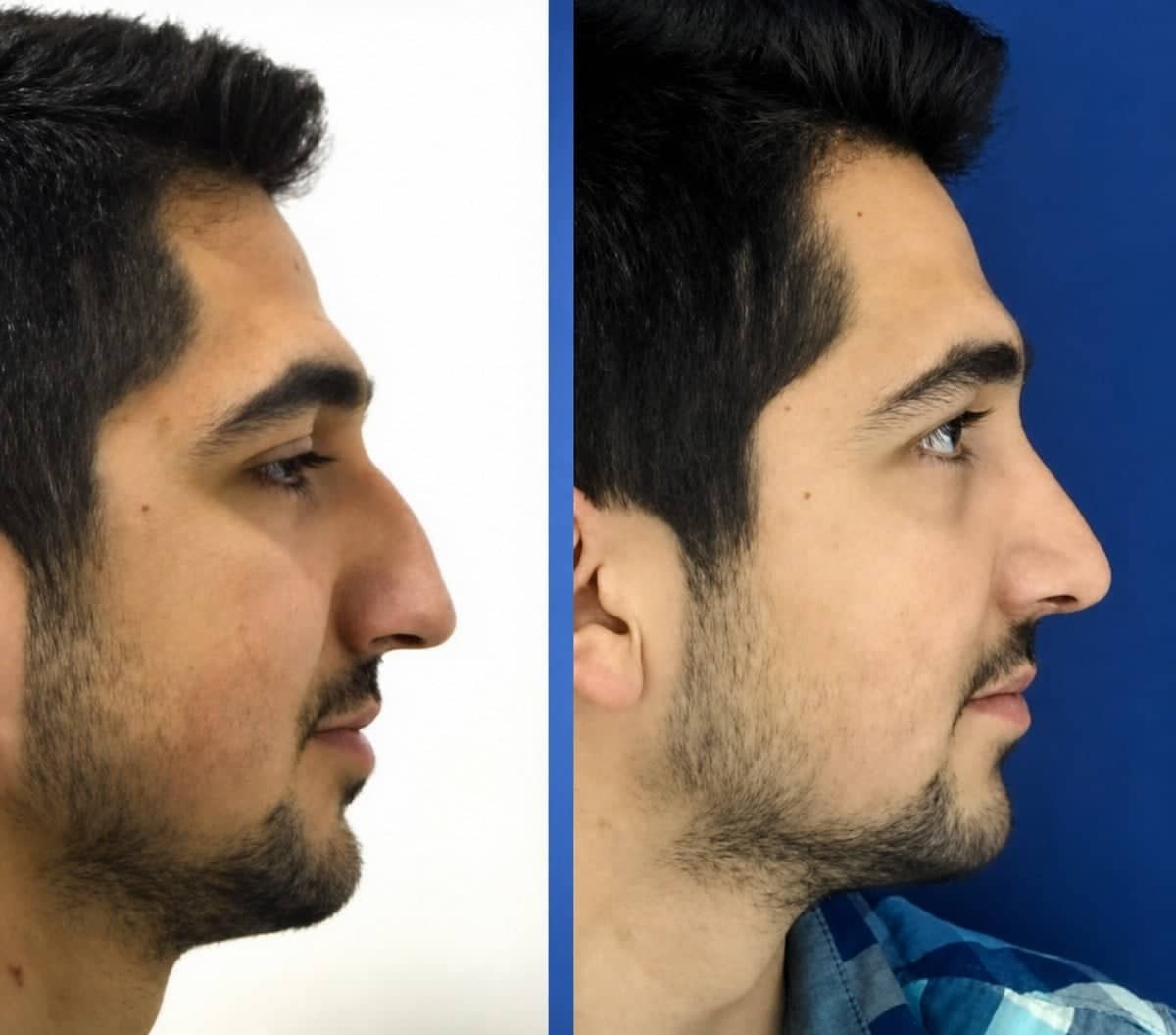 Case 12244 - rhinoplasty