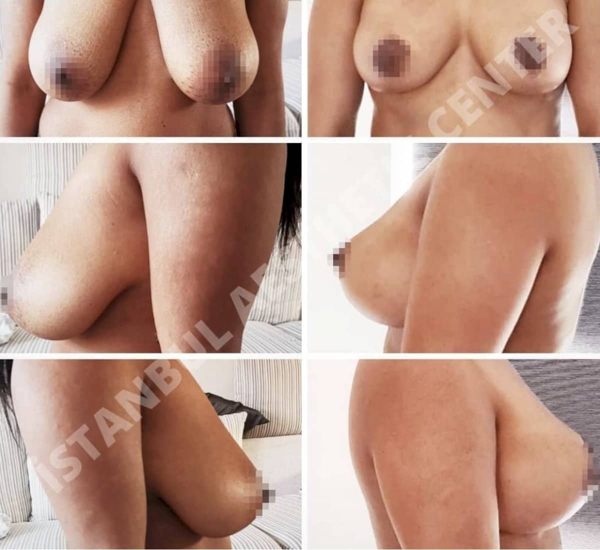 Case 12245 - breast implants with lift
