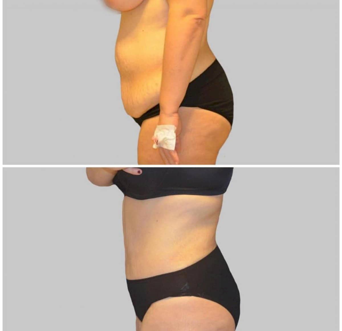Case 12247 - tummy tuck