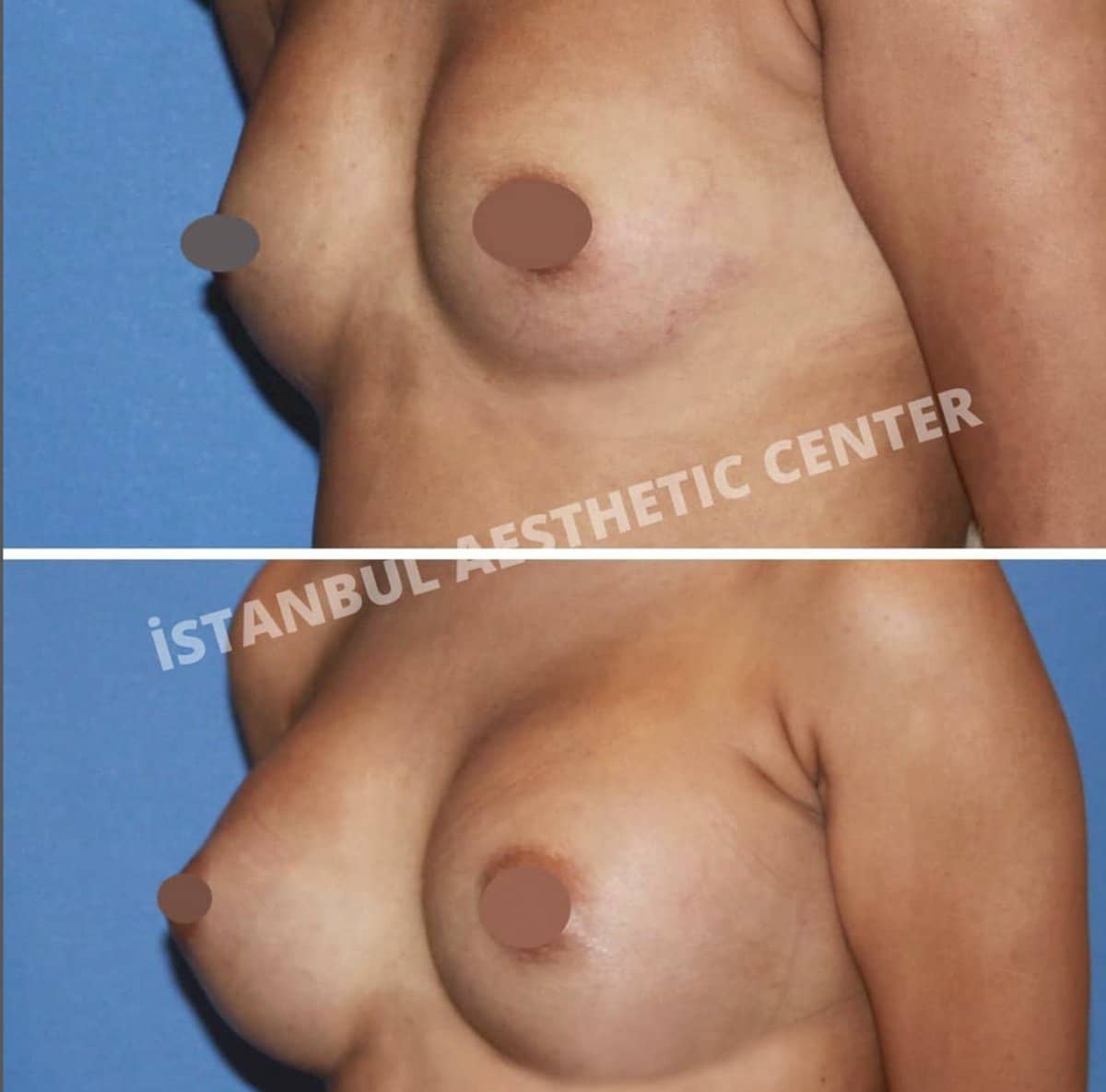 Case 12248 - breast augmentation