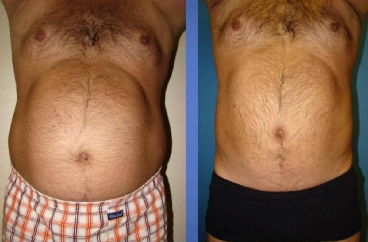 Case 12250 - liposuction 3 body areas