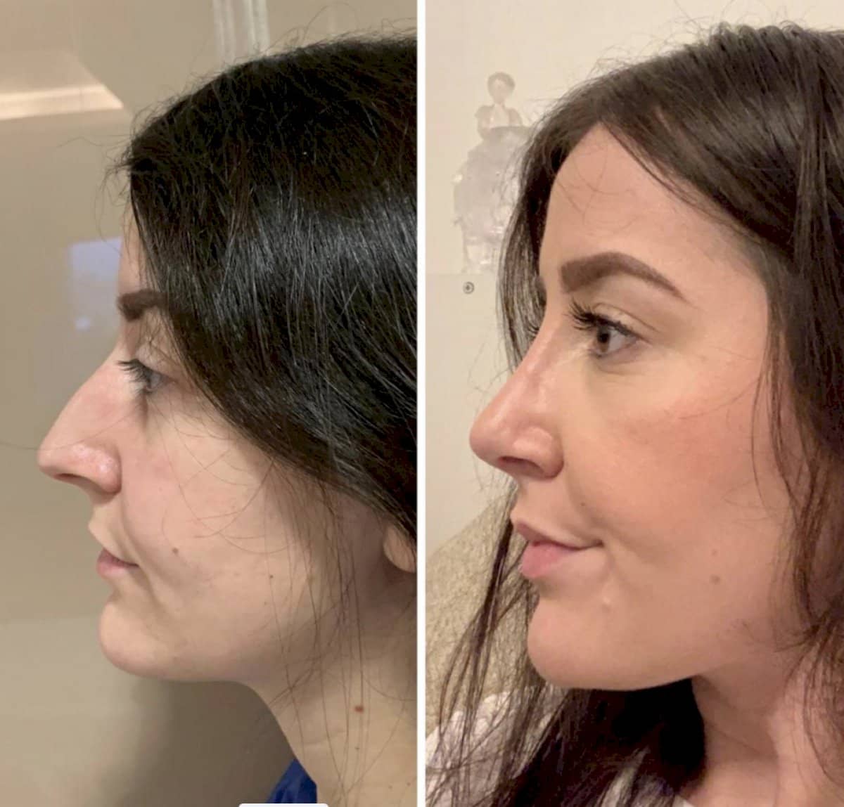 Case 12252 - rhinoplasty