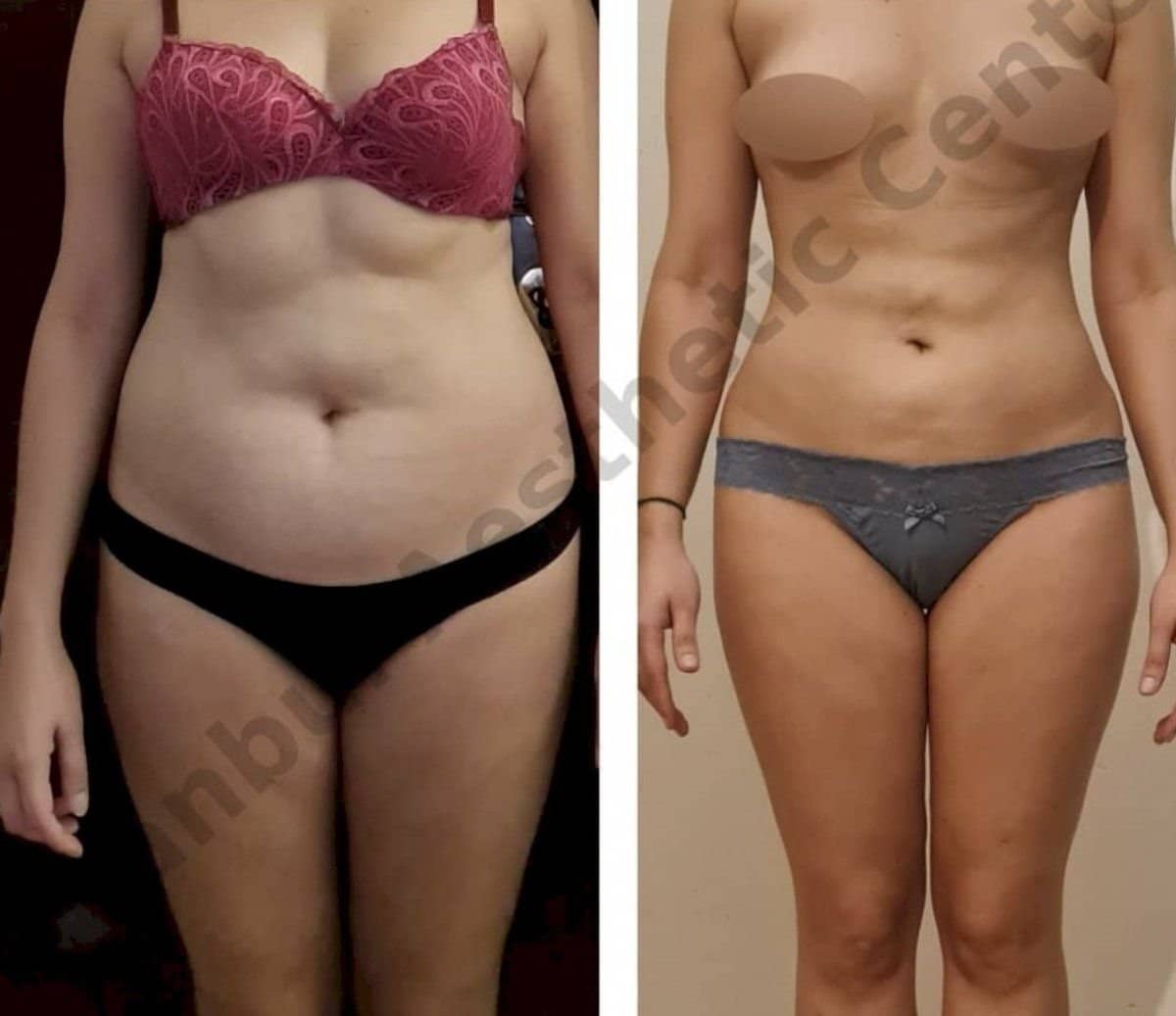 Case 12253 - liposuction 3 body areas