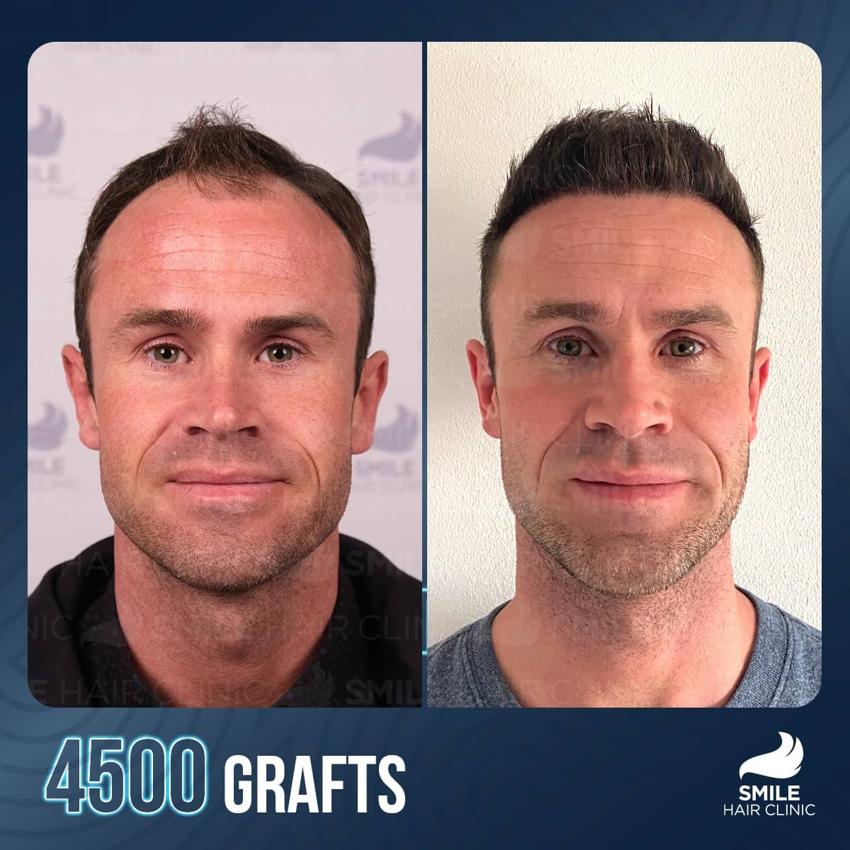 Case 12284 - result, 4500 grafts