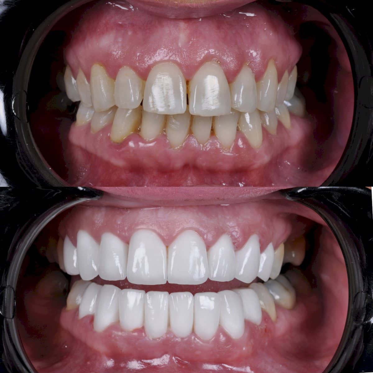 Case 12305 - porcelain veneer