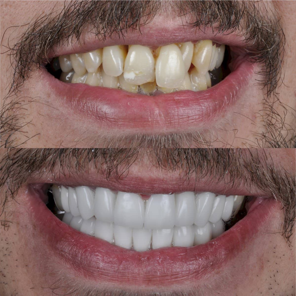 Case 12306 - dental crown installation