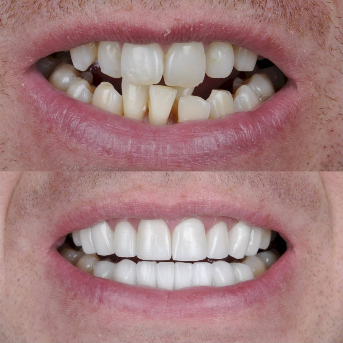 Case 12307 - porcelain veneer