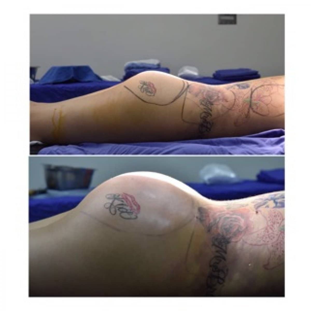 Case 12319 - liposuction
