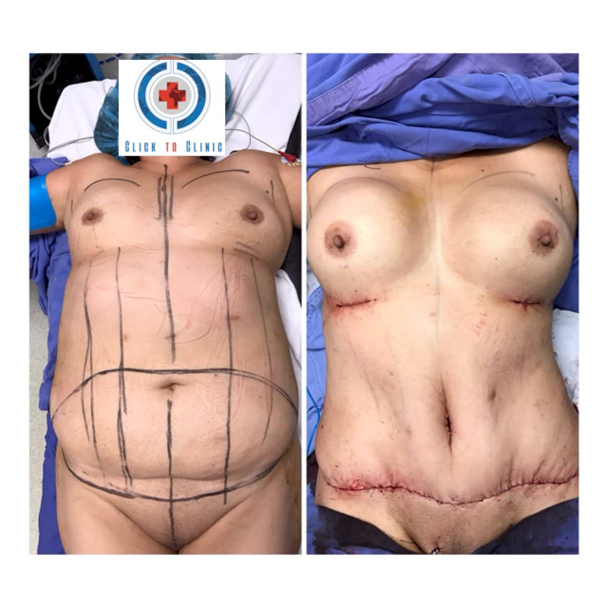 Case 12324 - tummy tuck