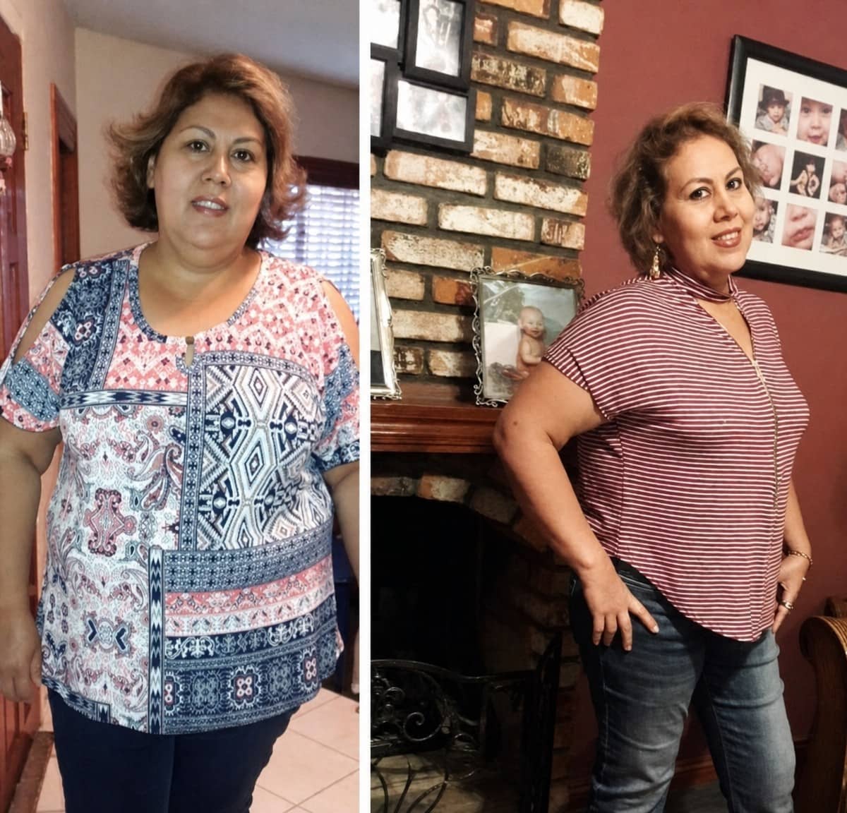 Case 12325 - gastric bypass