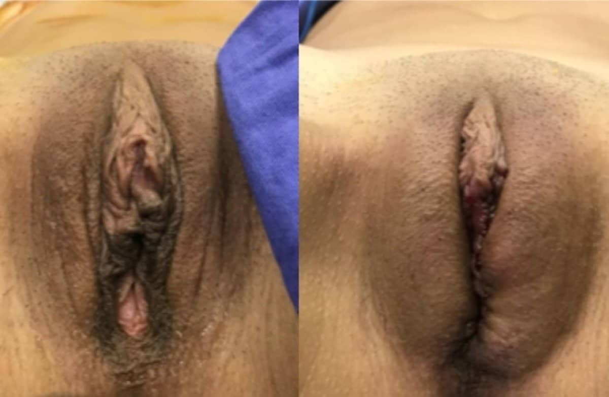 Case 12327 - vaginoplasty