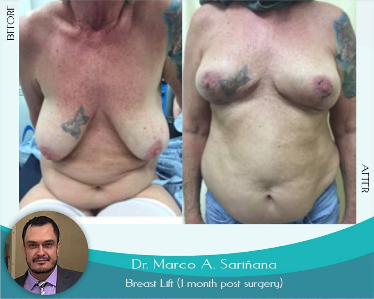 Case 12330 - breast lift