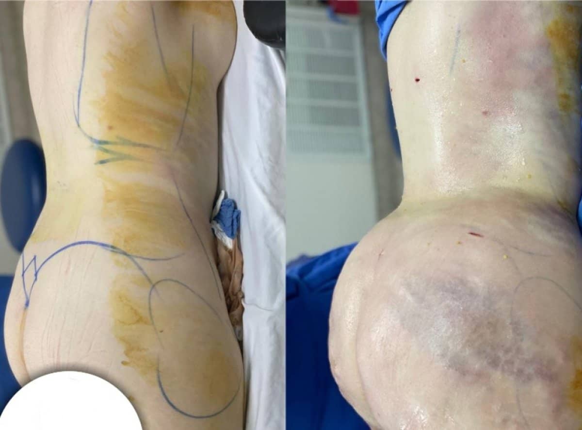 Case 12331 - Brazilian Butt Lift