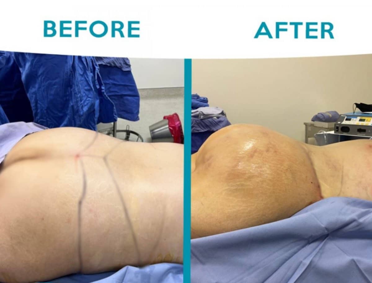 Case 12332 - tummy tuck
