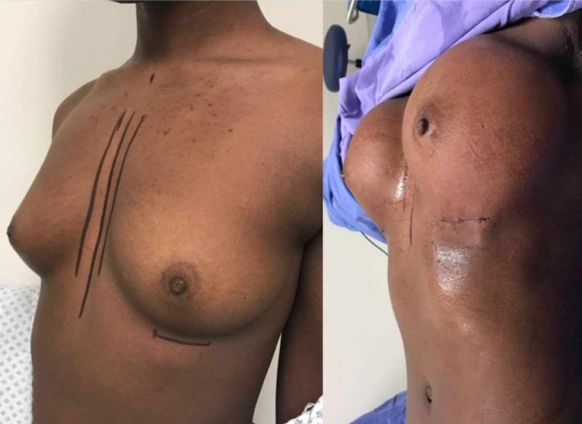 Case 12335 - breast augmentation