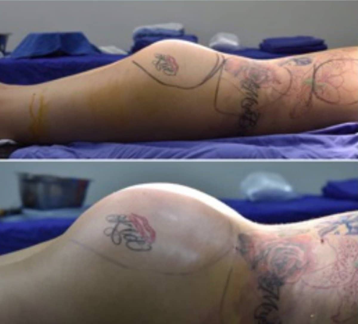 Case 12336 - Brazilian Butt Lift
