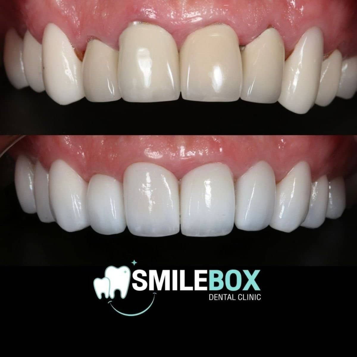 Case 12354 - dental crown installation