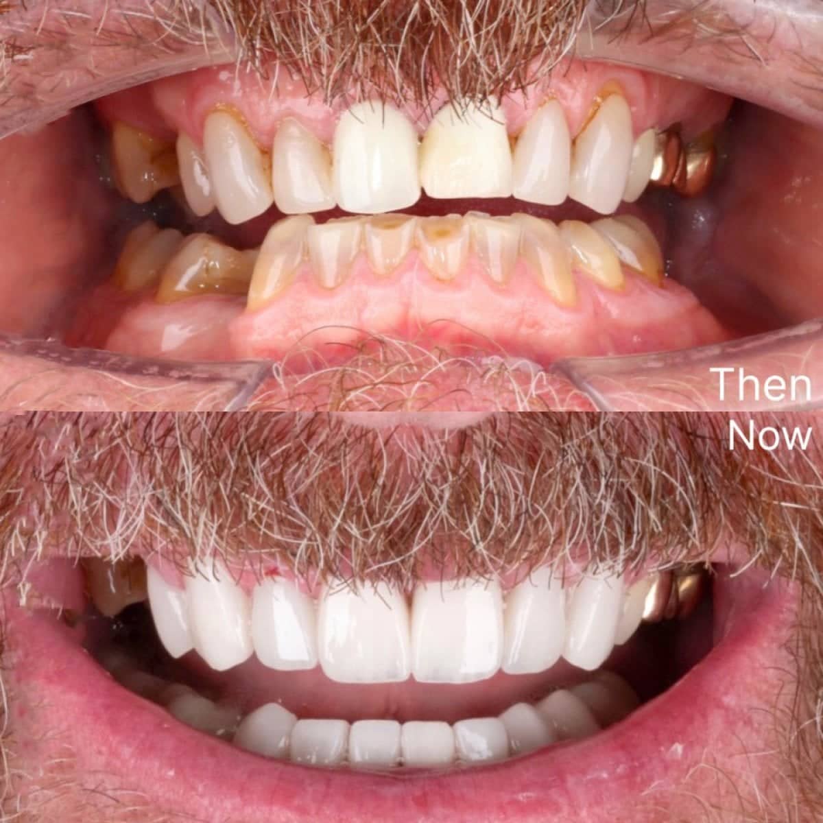 Case 12360 - dental veneers