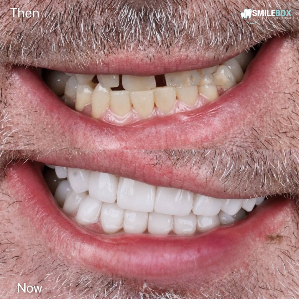 Case 12361 - denture