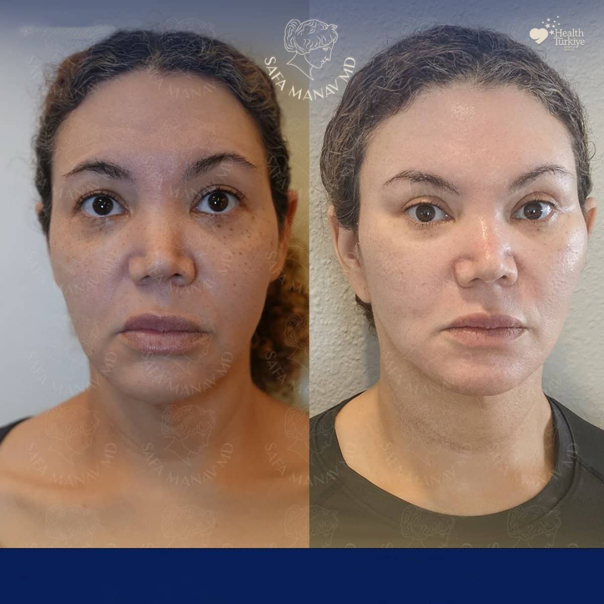 Case 12412 - breast implants with lift