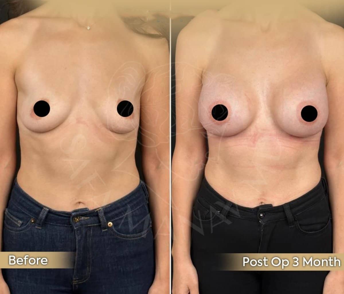 Case 12416 - Deep Plane Facelift