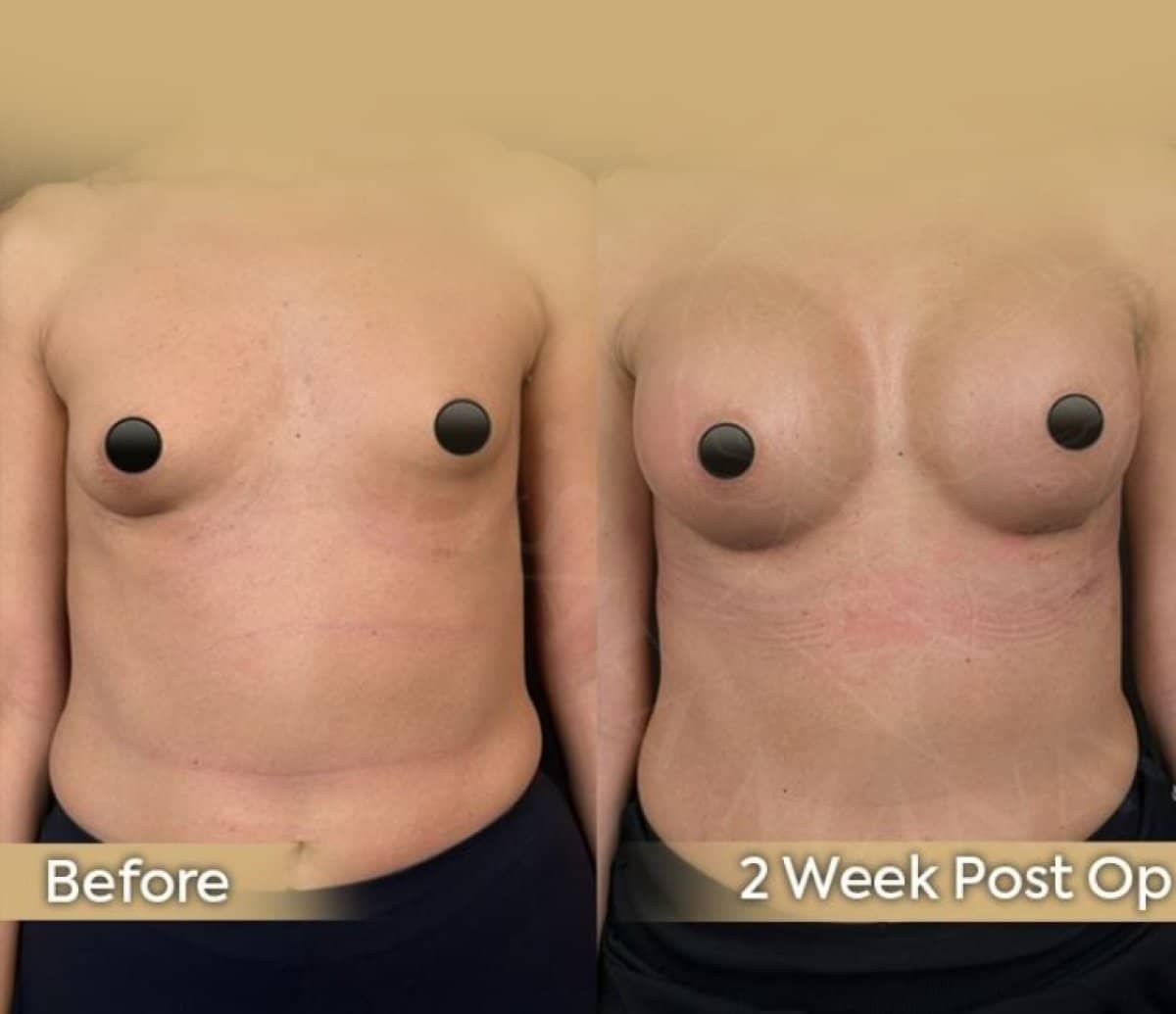 Case 12418 - blepharoplasty