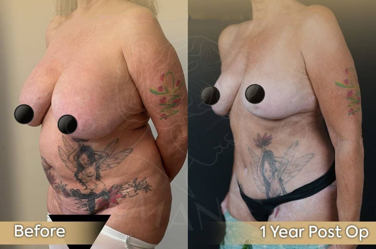 Case 12419 - breast augmentation with fat transfer