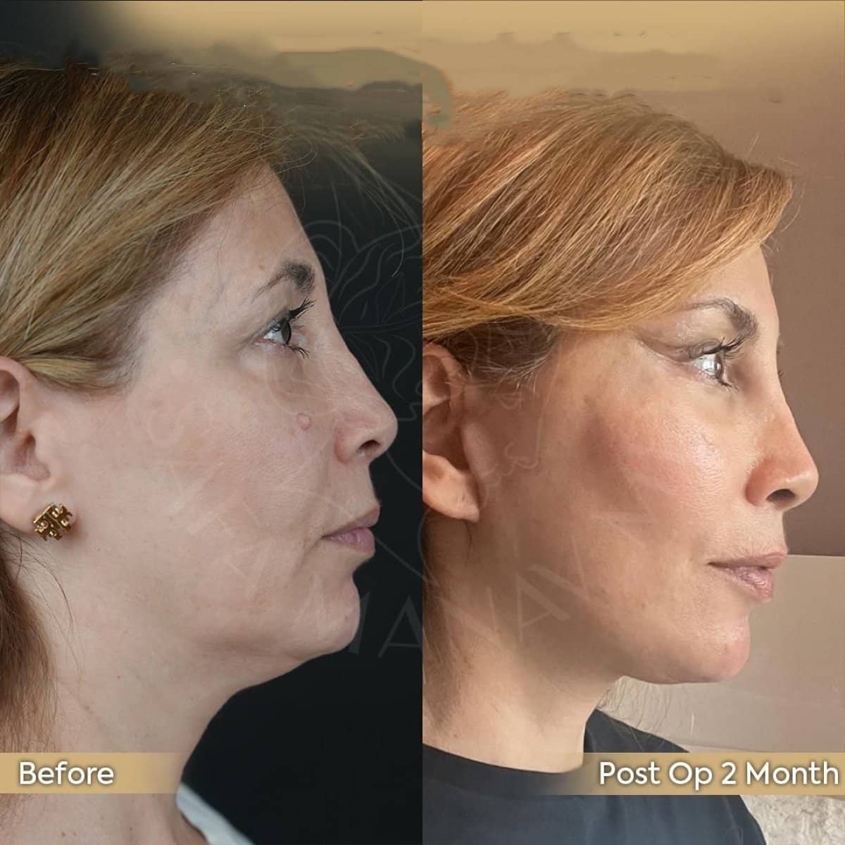 Case 12420 - deep plane facelift
