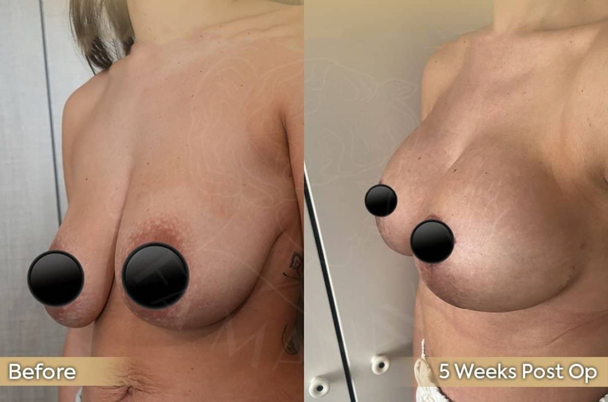 Case 12424 - neck lift