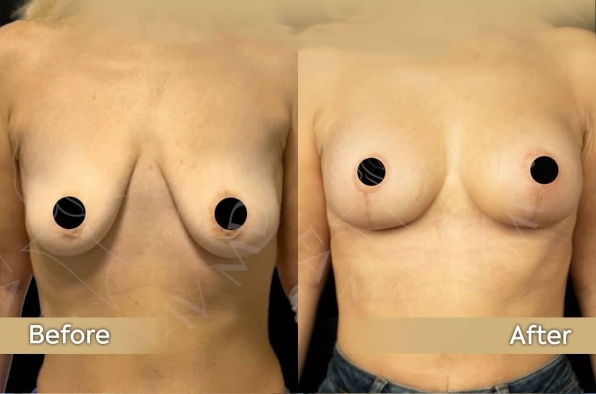 Case 12425 - neck lift