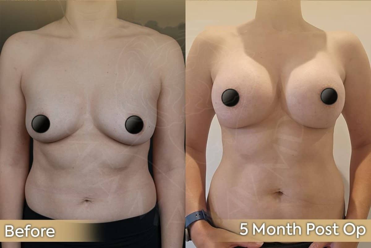 Case 12426 - breast augmentation
