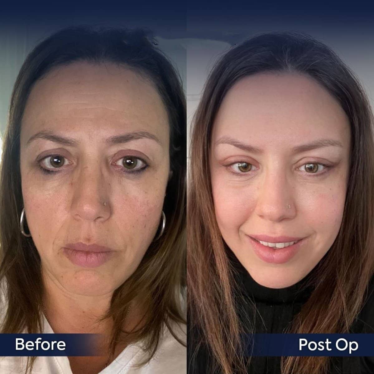 Case 12427 - rhinoplasty
