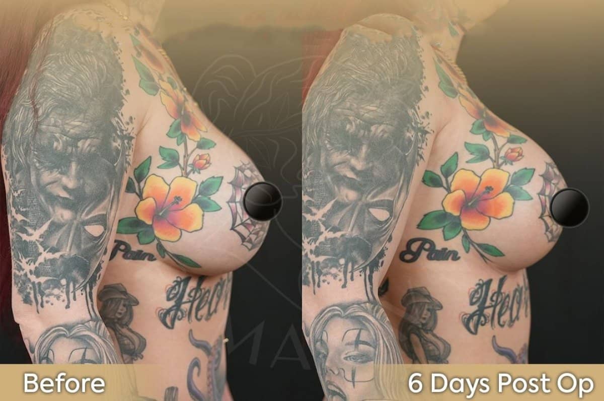 Case 12429 - breast lift with round implants