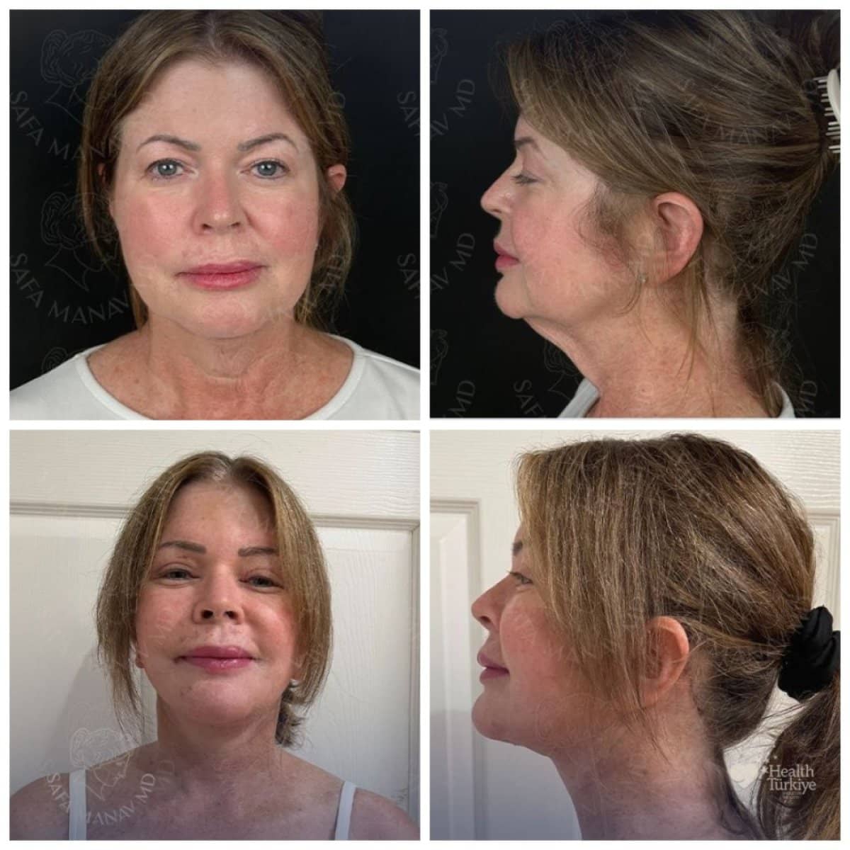 Case 12431 - breast lift