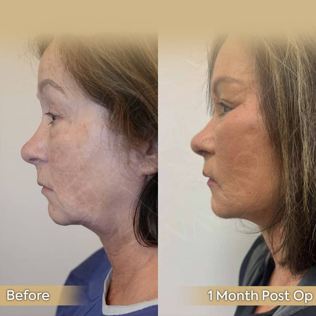 Case 12436 - breast lift