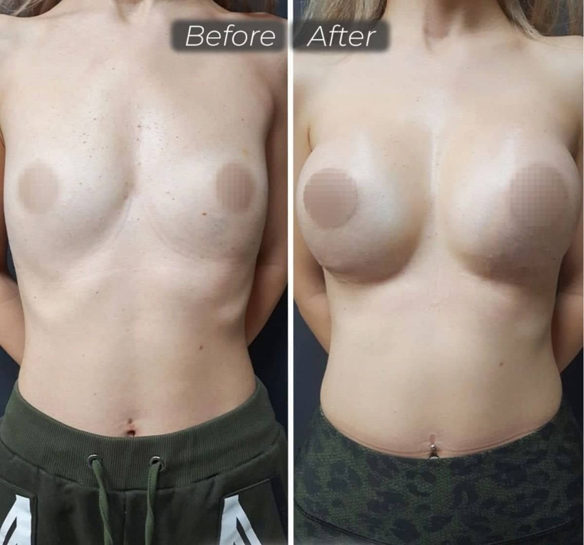 Case 12437 - breast implant removal