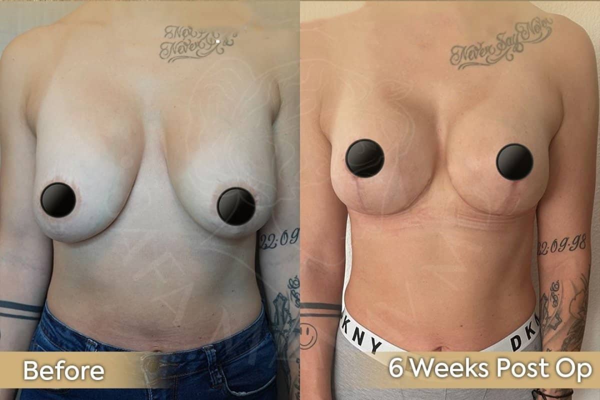 Case 12440 - breast implants with lift