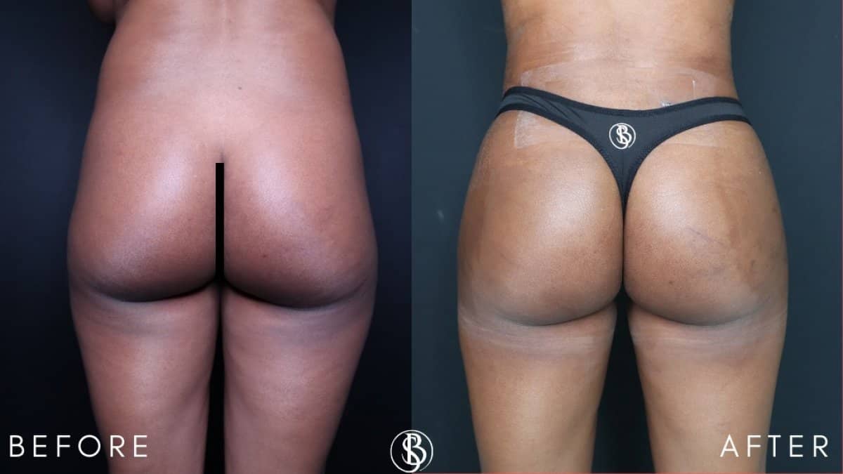 Case 12442 - abdominal etching