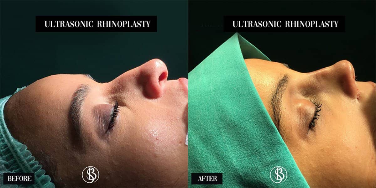Case 12445 - Brazilian Butt Lift