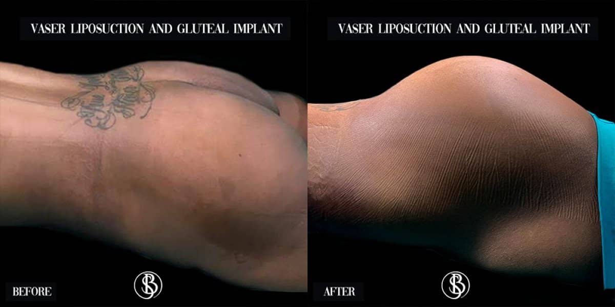 Case 12447 - tummy tuck and VASER liposuction