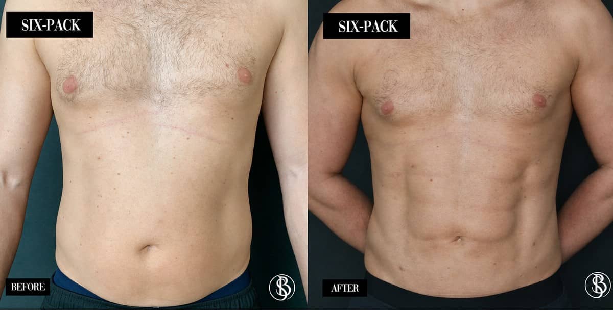Case 12448 - ultrasonic rhinoplasty