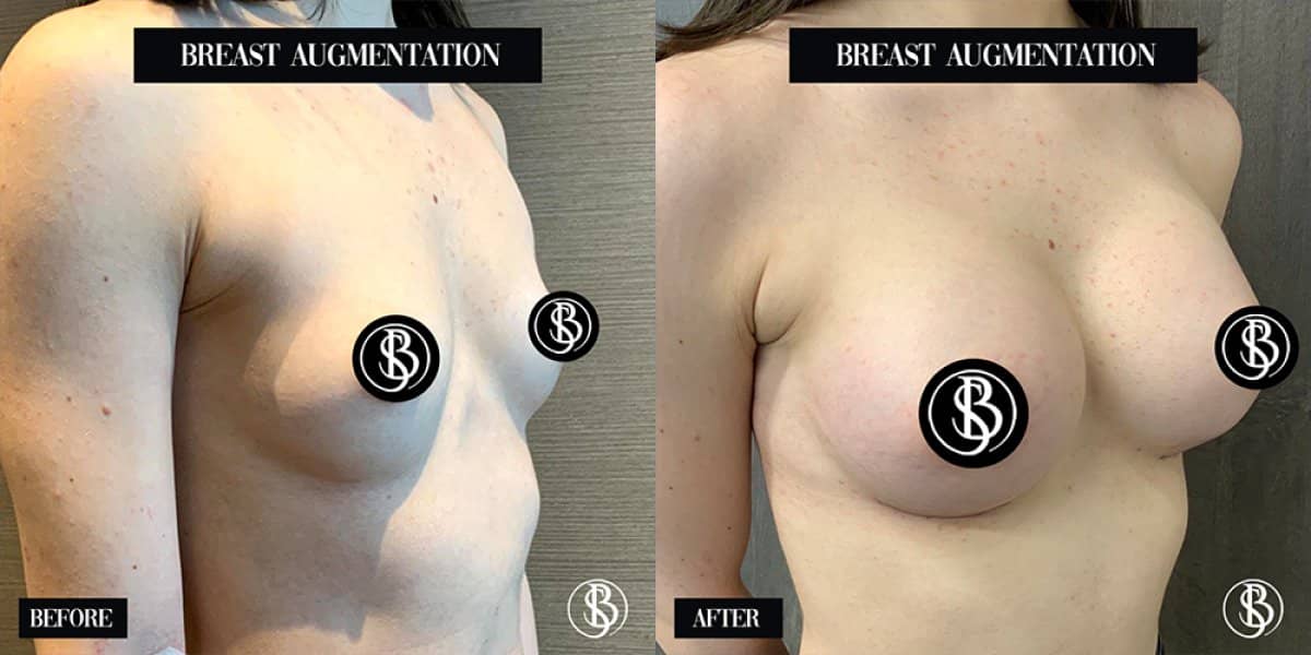 Case 12449 - six-pack liposuction