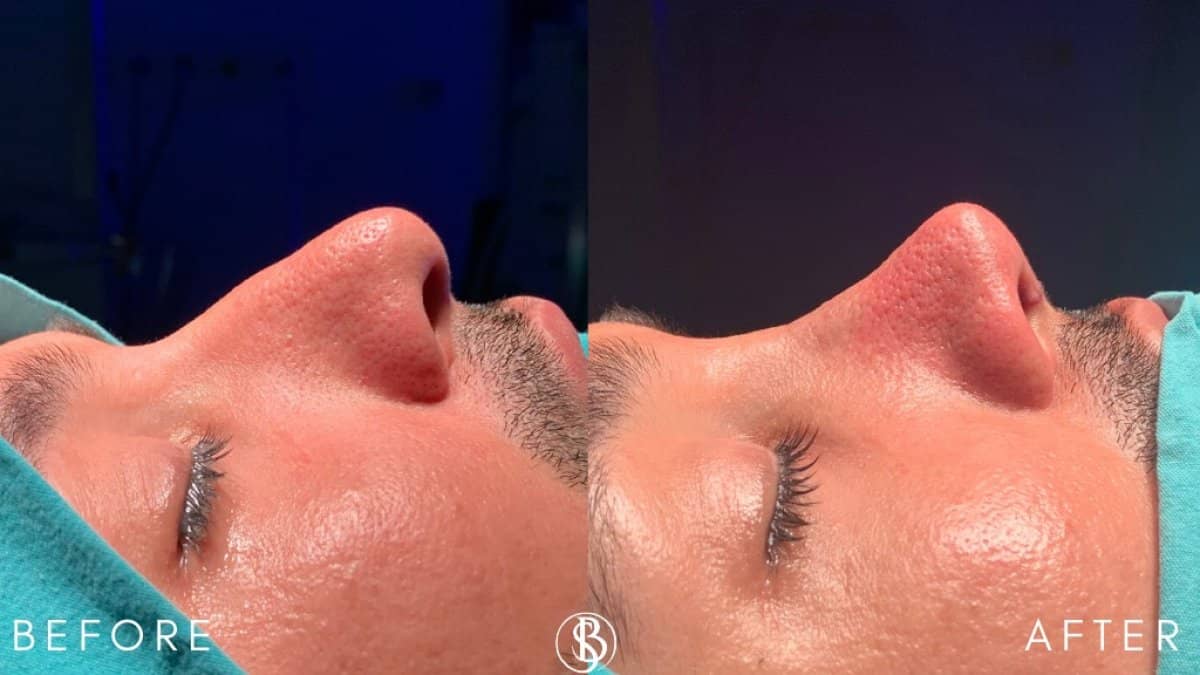 Case 12452 - rhinoplasty