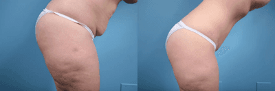 Case 1246 - Woman treated with Tummy Tuck