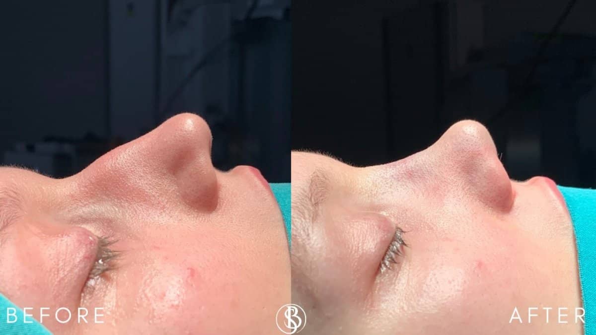 Case 12461 - rhinoplasty