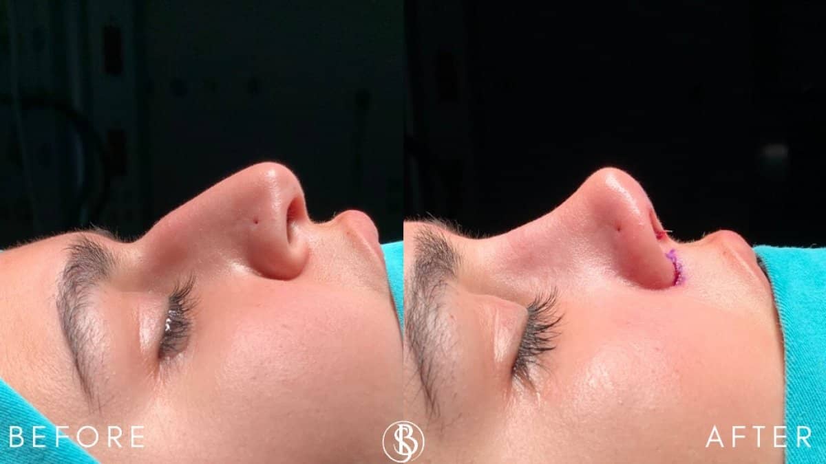 Case 12462 - rhinoplasty