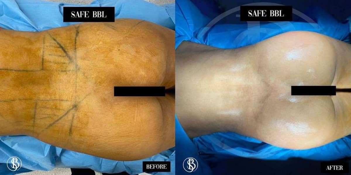 Case 12463 - breast lift